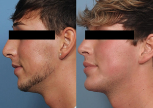 Chin Augmentation