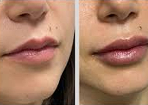 Beautification of Lip